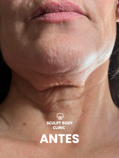 Antes 2